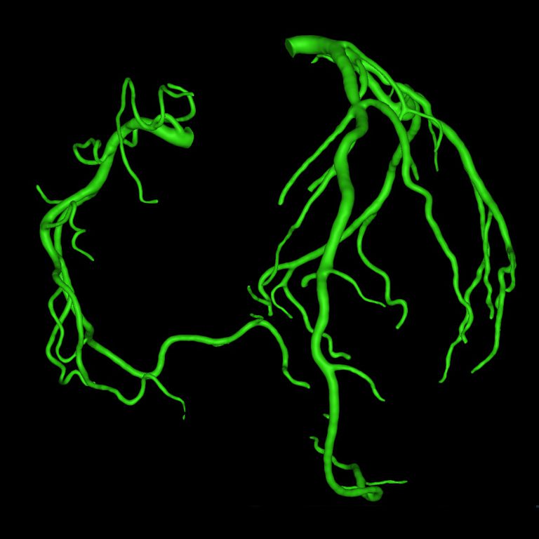 3d model of coronary vessels based on automatic segmentation