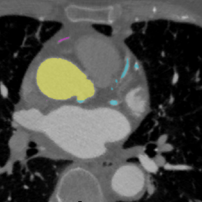 medical image segmentation of coronary arteries