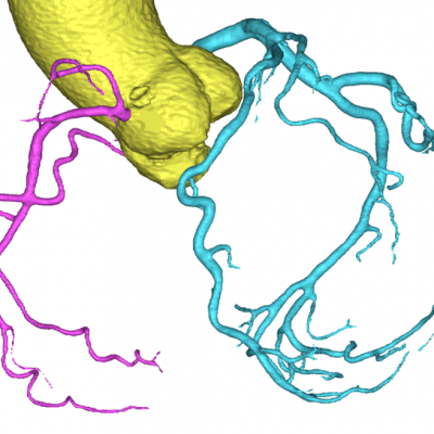 3d mask based on image segmentation of coronary arteries