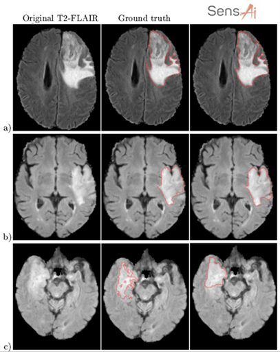 quality of segmentation in medical image analysis graylight brain dicoms with glioma contouring proving the quality of segmentation in medical image analysis