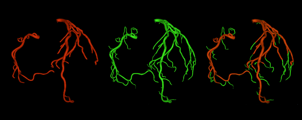 segmented coronary arteries thanks to medical image segmentation process 3 segmentation of coronary arteries proving the progress made by graylight imaging in medical image segmentation process