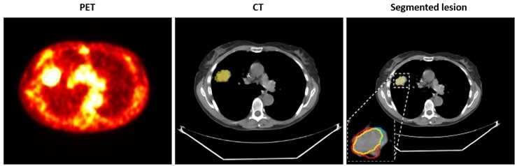 an example of active lesion detection lungs lesions