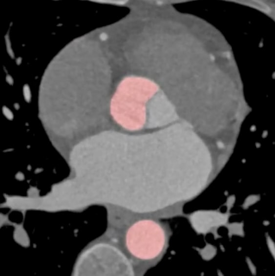 segmentation of thoracic aorta