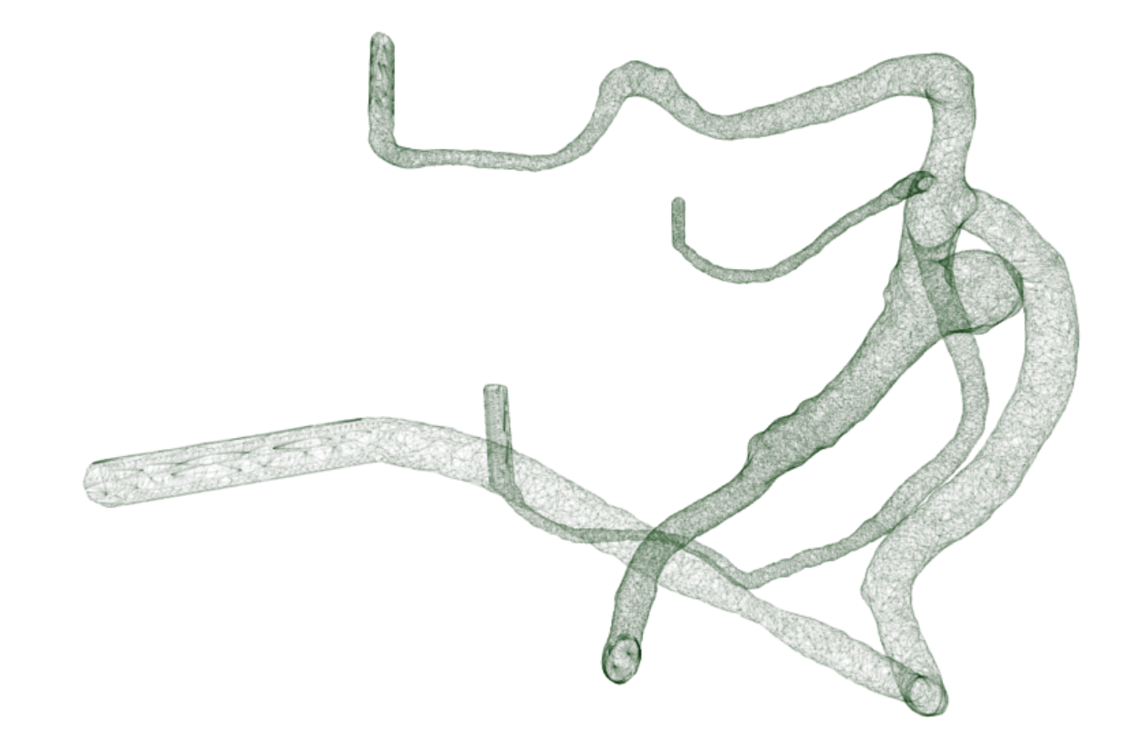 segmentation-aunerysm