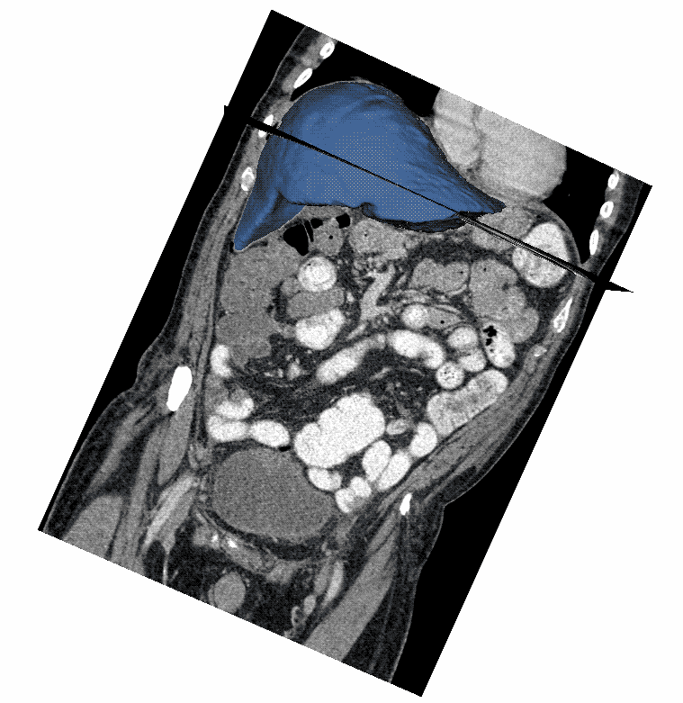 this animation is presented the results of liver tumor analysis
